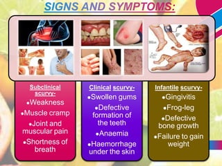 Scurvy Symptoms Scurvy May Be Re Emerging Amid Cost Of Living Crisis