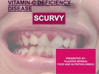 VITAMIN-C DEFICIENCY
DISEASE
PRESENTED BY-
TAJUDDIN MONDAL
FOOD AND NUTRITION (WBSU)
 