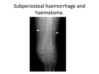 Subperiosteal haemorrhage and
haematoma.
 