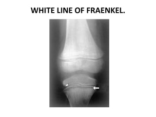 WHITE LINE OF FRAENKEL.
 