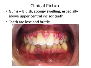 Clinical Picture
• Gums – Bluish, spongy swelling, especially
above upper central incisor teeth.
• Teeth are lose and brittle.
 