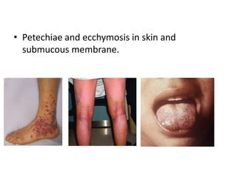 • Petechiae and ecchymosis in skin and
submucous membrane.
 