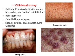 • Childhood scurvy
• Follicular hyperkeratosis with minute
hemorrhages at root of hair follicles.
• Hair, Teeth loss
• Petechial hemorrhages,
• Spongy, swollen, bluish purple gums ,
Gingivitis
• Subperiosteal hemorrhages.
Gingivitis
Corkscrew hair
 