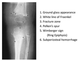 1. Ground glass appearance
2. White line of Fraenkel
3. Fracture zone
4. Pelken’s spur
5. Wimberger sign
(Ring Epiphysis)
6. Subperiosteal hemorrhage
 