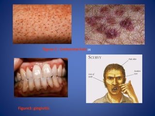 Severe scurvy an underestimated disease  European Journal of Clinical  Nutrition