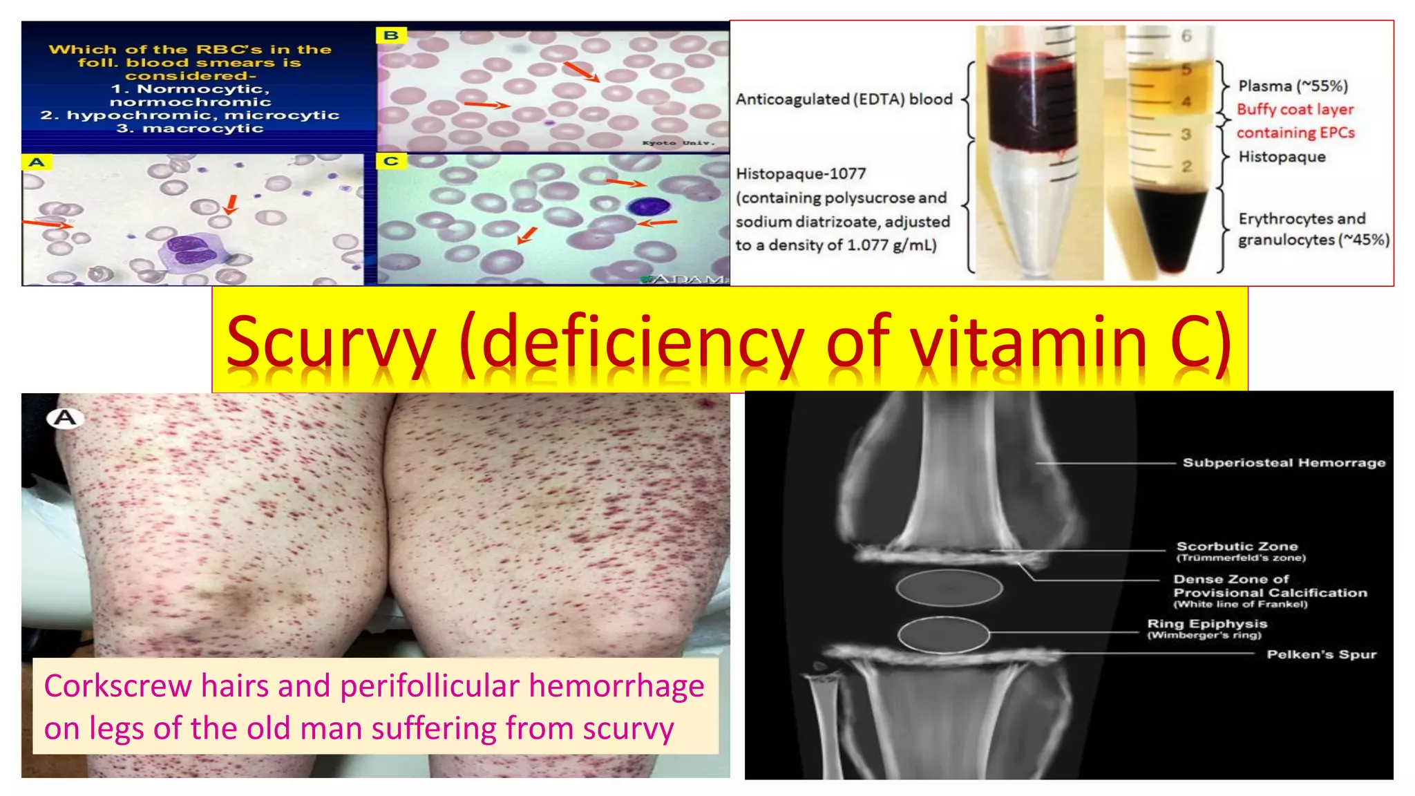 Scarvey Scurvy (deficiency of vitamin C) | PDF