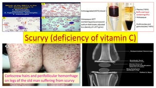 Scurvy (deficiency of vitamin C)
Corkscrew hairs and perifollicular hemorrhage
on legs of the old man suffering from scurvy
 