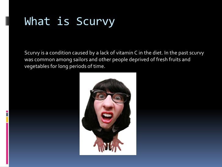 scurvy vitamin c and united nations Scurvy: vitamin c and united nations children scurvy is perhaps the oldest known deficiency disease however, its specific relationship to ascorbic acid was not recognized until the 20th century. scurvy vitamin c and united nations Scurvy: vitamin c and united nations children scurvy is perhaps the oldest known deficiency disease however, its specific relationship to ascorbic acid was not recognized until the 20th century.