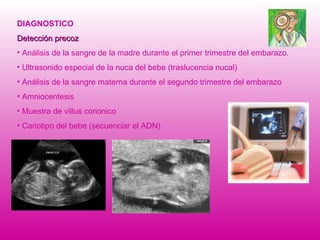 DIAGNOSTICO Detección precoz Análisis de la sangre de la madre durante el primer trimestre del embarazo. Ultrasonido especial de la nuca del bebe (traslucencia nucal) Análisis de la sangre materna durante el segundo trimestre del embarazo Amniocentesis Muestra de villus corionico Cariotipo del bebe (secuenciar el ADN) 