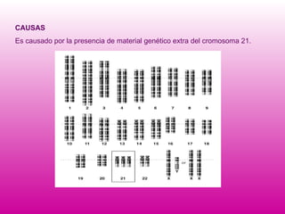 CAUSAS Es causado por la presencia de material genético extra del cromosoma 21.  