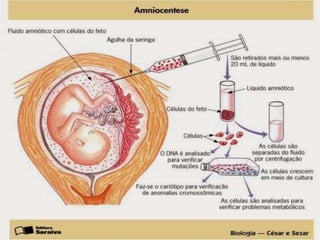 Sindrome de Down