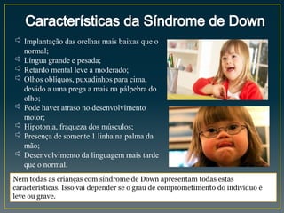⇨ Implantação das orelhas mais baixas que o
normal;
⇨ Língua grande e pesada;
⇨ Retardo mental leve a moderado;
⇨ Olhos oblíquos, puxadinhos para cima,
devido a uma prega a mais na pálpebra do
olho;
⇨ Pode haver atraso no desenvolvimento
motor;
⇨ Hipotonia, fraqueza dos músculos;
⇨ Presença de somente 1 linha na palma da
mão;
⇨ Desenvolvimento da linguagem mais tarde
que o normal.
Nem todas as crianças com síndrome de Down apresentam todas estas
características. Isso vai depender se o grau de comprometimento do indivíduo é
leve ou grave.
 