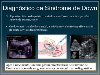 Diagnóstico da Síndrome de Down
⇨ É possível fazer o diagnóstico da síndrome de Down durante a gravidez
através de exames, como:
Após o nascimento, um bebê possui características de síndrome de
Down e um exame de sangue na criança pode confirmar o diagnóstico.
• Cordocentese, translucência nucal, amniocentese, ultrassonografia e através
da coleta de vilosidade coriônicas.
 