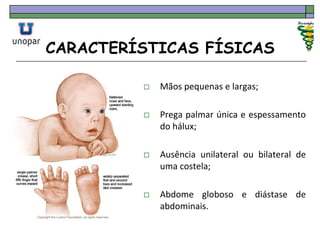 CARACTERÍSTICAS FÍSICAS
 Mãos pequenas e largas;
 Prega palmar única e espessamento
do hálux;
 Ausência unilateral ou bilateral de
uma costela;
 Abdome globoso e diástase de
abdominais.
 