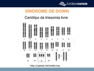 SÍNDROME DE DOWN
Cariótipo da trissomia livre
http://upload.wikimedia.orghttp://upload.wikimedia.org
 
