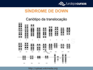 SÍNDROME DE DOWN
Cariótipo da translocação
http://upload.wikimedia.orghttp://upload.wikimedia.org
 