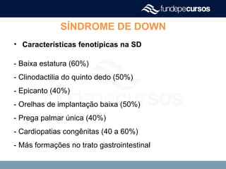 SÍNDROME DE DOWN
• Características fenotípicas na SD
- Baixa estatura (60%)
- Clinodactilia do quinto dedo (50%)
- Epicanto (40%)
- Orelhas de implantação baixa (50%)
- Prega palmar única (40%)
- Cardiopatias congênitas (40 a 60%)
- Más formações no trato gastrointestinal
 