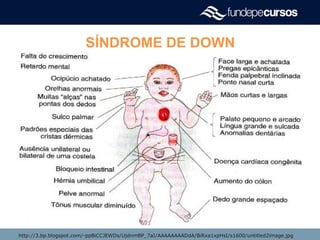 SÍNDROME DE DOWN
Características físicasCaracterísticas físicas
http://3.bp.blogspot.com/-ppBiCCJEWDs/UjdnmBP_7aI/AAAAAAAADdA/BiRxa1xpHsI/s1600/untitled2image.jpghttp://3.bp.blogspot.com/-ppBiCCJEWDs/UjdnmBP_7aI/AAAAAAAADdA/BiRxa1xpHsI/s1600/untitled2image.jpg
 
