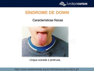 SÍNDROME DE DOWN
Características físicasCaracterísticas físicas
http://www.cerebromente.org.br/n04/doenca/down/fig7a.gifhttp://www.cerebromente.org.br/n04/doenca/down/fig7a.gif
Língua sulcada e protrusa.Língua sulcada e protrusa.
 