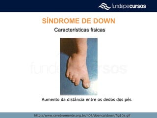 SÍNDROME DE DOWN
Características físicasCaracterísticas físicas
Aumento da distância entre os dedos dos pésAumento da distância entre os dedos dos pés
http://www.cerebromente.org.br/n04/doenca/down/fig10a.gifhttp://www.cerebromente.org.br/n04/doenca/down/fig10a.gif
 