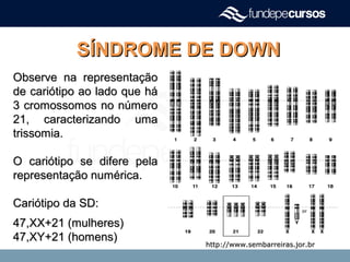 SÍNDROME DE DOWNSÍNDROME DE DOWN
Observe na representaçãoObserve na representação
de cariótipo ao lado que háde cariótipo ao lado que há
3 cromossomos no número3 cromossomos no número
21, caracterizando uma21, caracterizando uma
trissomia.trissomia.
O cariótipo se difere pelaO cariótipo se difere pela
representação numérica.representação numérica.
Cariótipo da SD:Cariótipo da SD:
47,XX+21 (mulheres)47,XX+21 (mulheres)
47,XY+21 (homens)47,XY+21 (homens)
http://www.sembarreiras.jor.brhttp://www.sembarreiras.jor.br
 