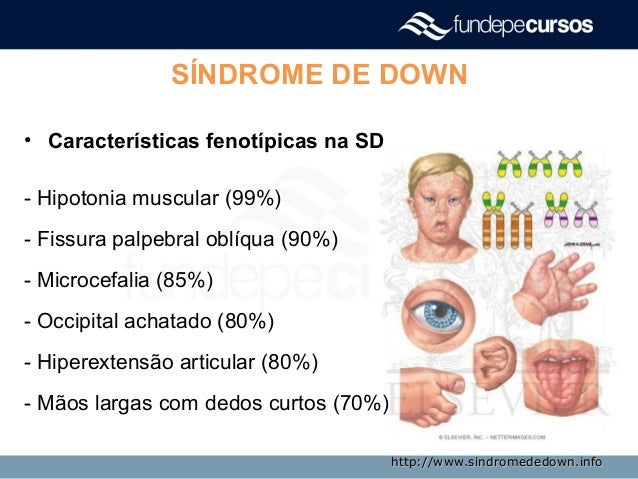 Sindrome De Down Caracteristicas - Características físicas del síndrome