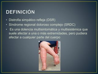 • Distrofia simpático refleja (DSR)
• Síndrome regional doloroso complejo (SRDC)
• Es una dolencia multisintomática y multisistémica que
suele afectar a una o más extremidades, pero pudiera
afectar a cualquier parte del cuerpo
 