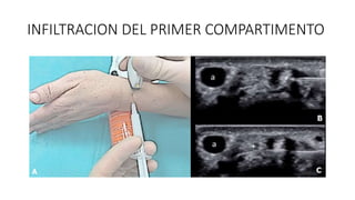 INFILTRACION DEL PRIMER COMPARTIMENTO
 