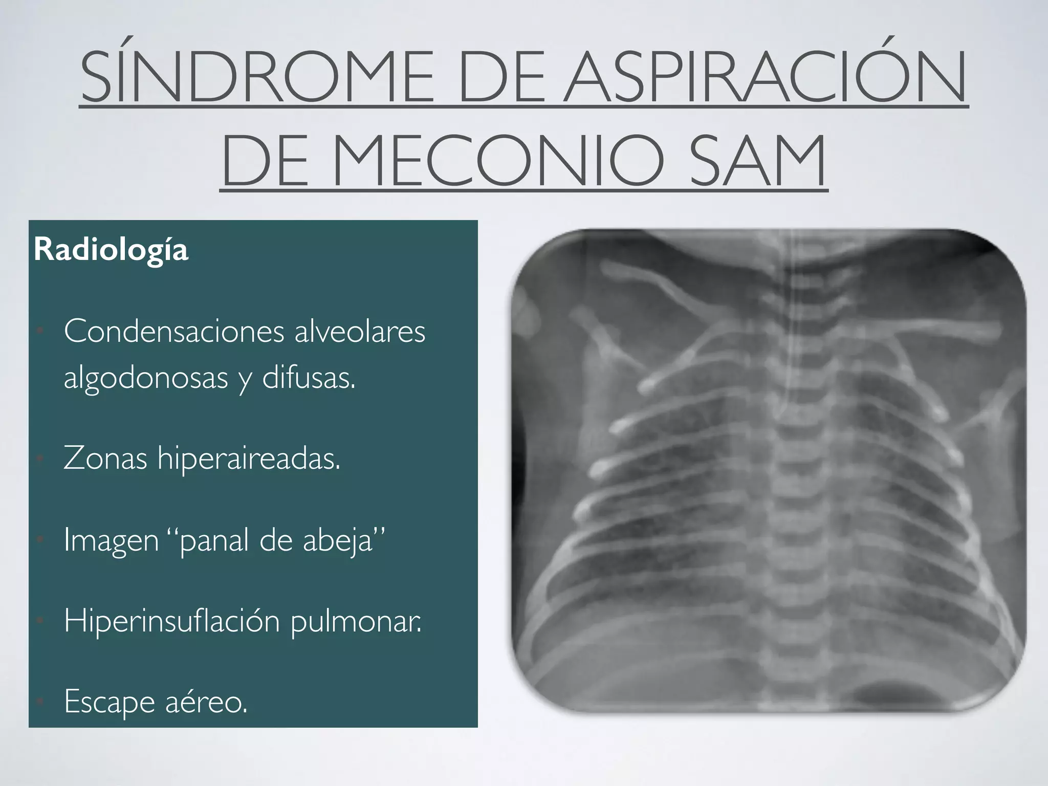 SÍNDROME DE ASPIRACIÓN
DE MECONIO SAM
Radiología
• Condensaciones alveolares
algodonosas y difusas.
• Zonas hiperaireadas.
• Imagen “panal de abeja”
• Hiperinsuﬂación pulmonar.
• Escape aéreo.
 