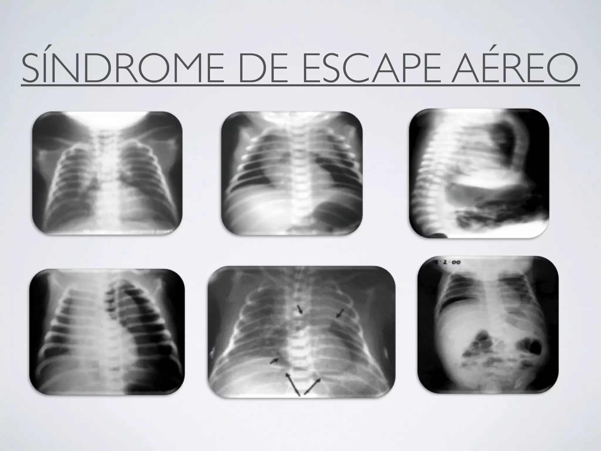 SÍNDROME DE ESCAPE AÉREO
 