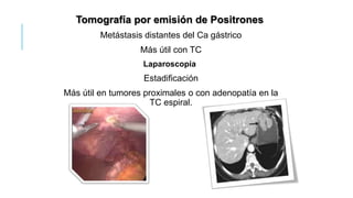 Tomografía por emisión de Positrones
Metástasis distantes del Ca gástrico
Más útil con TC
Laparoscopia
Estadificación
Más útil en tumores proximales o con adenopatía en la
TC espiral.
 