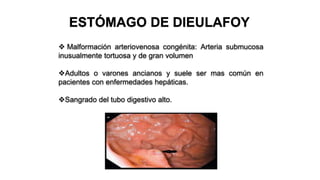 ESTÓMAGO DE DIEULAFOY
 Malformación arteriovenosa congénita: Arteria submucosa
inusualmente tortuosa y de gran volumen
Adultos o varones ancianos y suele ser mas común en
pacientes con enfermedades hepáticas.
Sangrado del tubo digestivo alto.
 