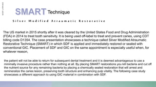 S i l v e r M o d i f i e d A t r a u m a t i c R e s t o r a t i v e
D
R
/
N
A
I
F
A
S
I
R
I
The US market in 2015 shortly after it was cleared by the United States Food and Drug Administration
(FDA) in 2014 to treat tooth sensitivity. It is being used off-label to treat and prevent caries, using CDT
billing code D1354. The case presentation showcases a technique called Silver Modified Atraumatic
Restorative Technique (SMART) in which SDF is applied and immediately restored or sealed with
conventional GIC. Placement of SDF and GIC on the same appointment is especially useful when, for
whatever reason,
Technique
the patient will not be able to return for subsequent dental treatment and it is deemed advantageous to use a
minimally invasive procedure rather than nothing at all. By placing SMART restorations you kill bacteria and cut off
the nutrient source for any remaining bacteria by placing a chemically sealed restoration that will arrest and
remineralize the caries lesion, preserving tooth structure and enhancing pulp vitality. The following case study
showcases a different approach to using GIC material in combination with SDF.
 