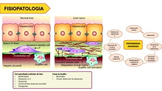 FISIOPATOLOGIA
Cel estrellada (células de Ito):
• Miofibroblasto
• Almacenan vit. A
• Quiescente
• Control del flujo sanguíneo sinusoidal
• Fibrogénesis
Celula de Kupffer:
• Macrófagos
• Cirrosis: destrucción de hepatocitos
ENFERMEDAD
AVANZADA
Inflamación
crónica
Reparación
Activación
de células
Estrelladas
Persistencia
de la
inflamación
Miofibroblasto
s Síntesis de
colágeno
Fibrosis
progresiva
Alteración de
la micro
circulación
Nódulos de
regeneració
n
 