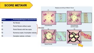 SCORE METAVIR
fibrosis
 