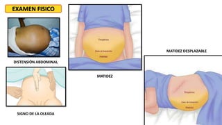 EXAMEN FISICO
DISTENSIÓN ABDOMINAL
SIGNO DE LA OLEADA
MATIDEZ
MATIDEZ DESPLAZABLE
 