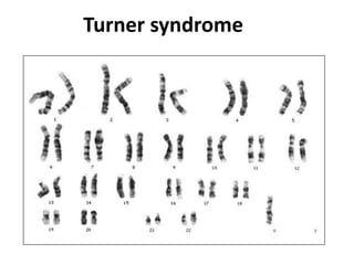 Turner syndrome
 