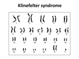 Klinefelter syndrome
 