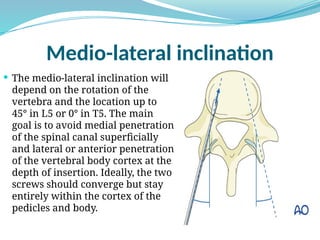 Posterior pedicular spine screws entry points | PPSX