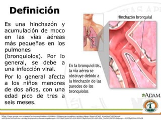 Definición
Es una hinchazón y
acumulación de moco
en las vías aéreas
más pequeñas en los
pulmones
(bronquiolos). Por lo
general, se debe a
una infección viral.
Por lo general afecta
a los niños menores
de dos años, con una
edad pico de tres a
seis meses.
https://www.google.com.co/search?q=bronquiolitis&biw=1366&bih=599&source=lnms&tbm=isch&sa=X&sqi=2&ved=0CAYQ_AUoAWoVChMI74bzxrK-
yAIVQh4eCh0zYgil#tbm=isch&q=bronquiolitis+fisiopatologia&imgdii=XDPZBgiM2KpUEM%3A%3BXDPZBgiM2KpUEM%3A%3Bw_CHxSlLbJIA7M%3A&imgrc=XDPZBgiM2KpUEM%3A
 