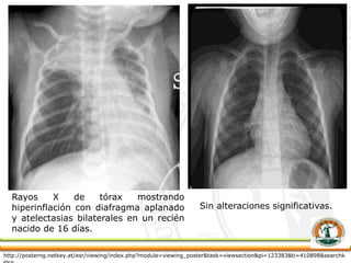 Rayos X de tórax mostrando
hiperinflación con diafragma aplanado
y atelectasias bilaterales en un recién
nacido de 16 días.
Sin alteraciones significativas.
http://posterng.netkey.at/esr/viewing/index.php?module=viewing_poster&task=viewsection&pi=123383&ti=410898&searchk
 