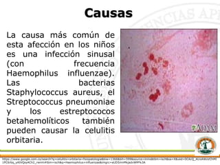 Causas
La causa más común de
esta afección en los niños
es una infección sinusal
(con frecuencia
Haemophilus influenzae).
Las bacterias
Staphylococcus aureus, el
Streptococcus pneumoniae
y los estreptococos
betahemolíticos también
pueden causar la celulitis
orbitaria.
https://www.google.com.co/search?q=celulitis+orbitaria+fisiopatologia&biw=1366&bih=599&source=lnms&tbm=isch&sa=X&ved=0CAcQ_AUoAWoVChMI
1PC6rbq_yAIVQsyACh2_rwnm#tbm=isch&q=Haemophilus+influenzae&imgrc=aUD5mnMkjadvWM%3A
 