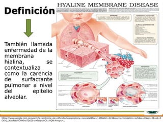 Definición
También llamada
enfermedad de la
membrana
hialina, se
contextualiza
como la carencia
de surfactante
pulmonar a nivel
del epitelio
alveolar.
https://www.google.com.co/search?q=sindrome+de+dificultad+respiratoria+neonatal&biw=1366&bih=643&source=lnms&tbm=isch&sa=X&sqi=2&ved=0
CAYQ_AUoAWoVChMInoTQvZS-yAIVQnUeCh1iVQfX#imgrc=_
 