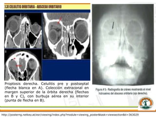 Proptosis derecha. Celulitis pre y postseptal
(flecha blanca en A). Colección extraconal en
margen superior de la órbita derecha (flechas
en B y C), con burbuja aérea en su interior
(punta de flecha en B).
http://posterng.netkey.at/esr/viewing/index.php?module=viewing_poster&task=viewsection&ti=363029
 