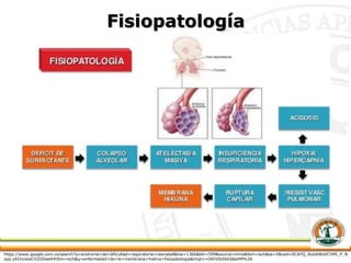 Fisiopatología
https://www.google.com.co/search?q=sindrome+de+dificultad+respiratoria+neonatal&biw=1366&bih=599&source=lnms&tbm=isch&sa=X&ved=0CAYQ_AUoAWoVChMI_P_N
zpq-yAIVxxkeCh2OOwe9#tbm=isch&q=enfermedad+de+la+membrana+hialina+fisiopatologia&imgrc=O6FkStXbkS8aHM%3A
 