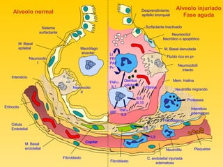 Macrófago alveolar Neumocito II Neumocito I Sistema surfactante M. Basal  epitelial Intersticio  Fibroblasto  M. Basal  endotelial Célula Endotelial  Eritrocito  Capilar  Alveolo normal  Plaquetas  Neutrófilo  Fibroblasto  C. endotelial injuriada edematosa Fluído rico en pr- Desprendimiento epitelio bronquial NeumocitoI Necrótico o apoptótico NeumocitoII intacto Surfactante inactivado M. Basal denudada Lt FR PAF Pr- Detritus celulares TNF  IL1 MIF TNF  IL8 IL6 IL10 Fibrina  Mem. hialina Neutrófilo migrando Proteasas  Intersticio  edematoso IL8 IL8 Procolágeno  Alveolo injuriado Fase aguda 