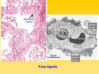 neutrófilo capilar hematíe Memb. basal Memb. basal 1 2 Fase Aguda Membrana hialina 