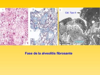 Cél. Tipo II  colágeno 3  2 1  Fase de la alveolitis fibrosante 