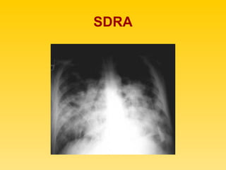 SDRA 