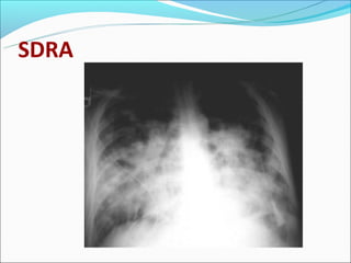 Sdra | PPT